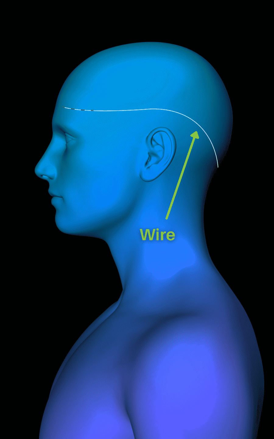 The Reed Procedure® Migraine Treatment & Relief