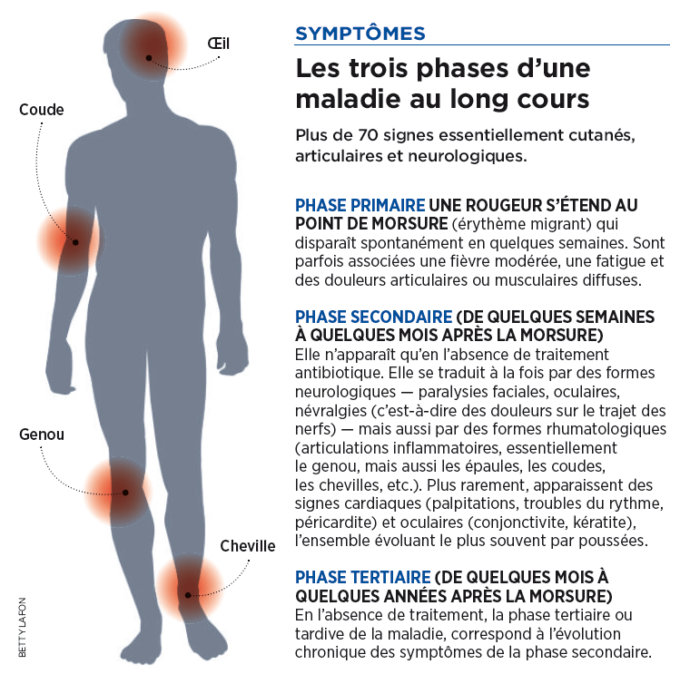 Maladie de Lyme Causes, Symptômes, Traitement,.