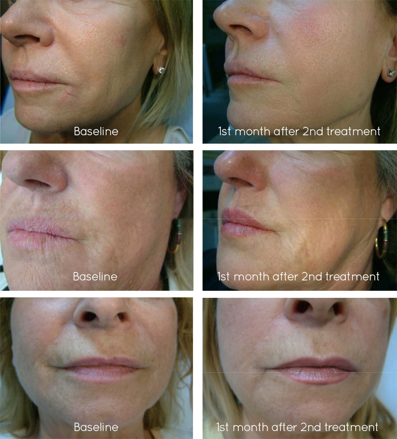 Profhilo the revolutionary new antiageing treatment Refine Me