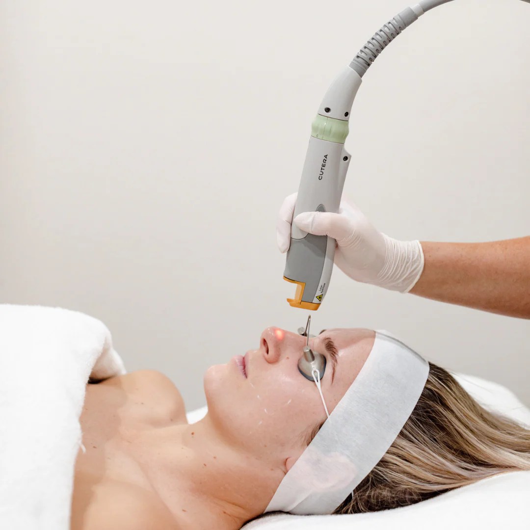 Laser Genesis Treatment Menu Albury Wodonga Refine Skin