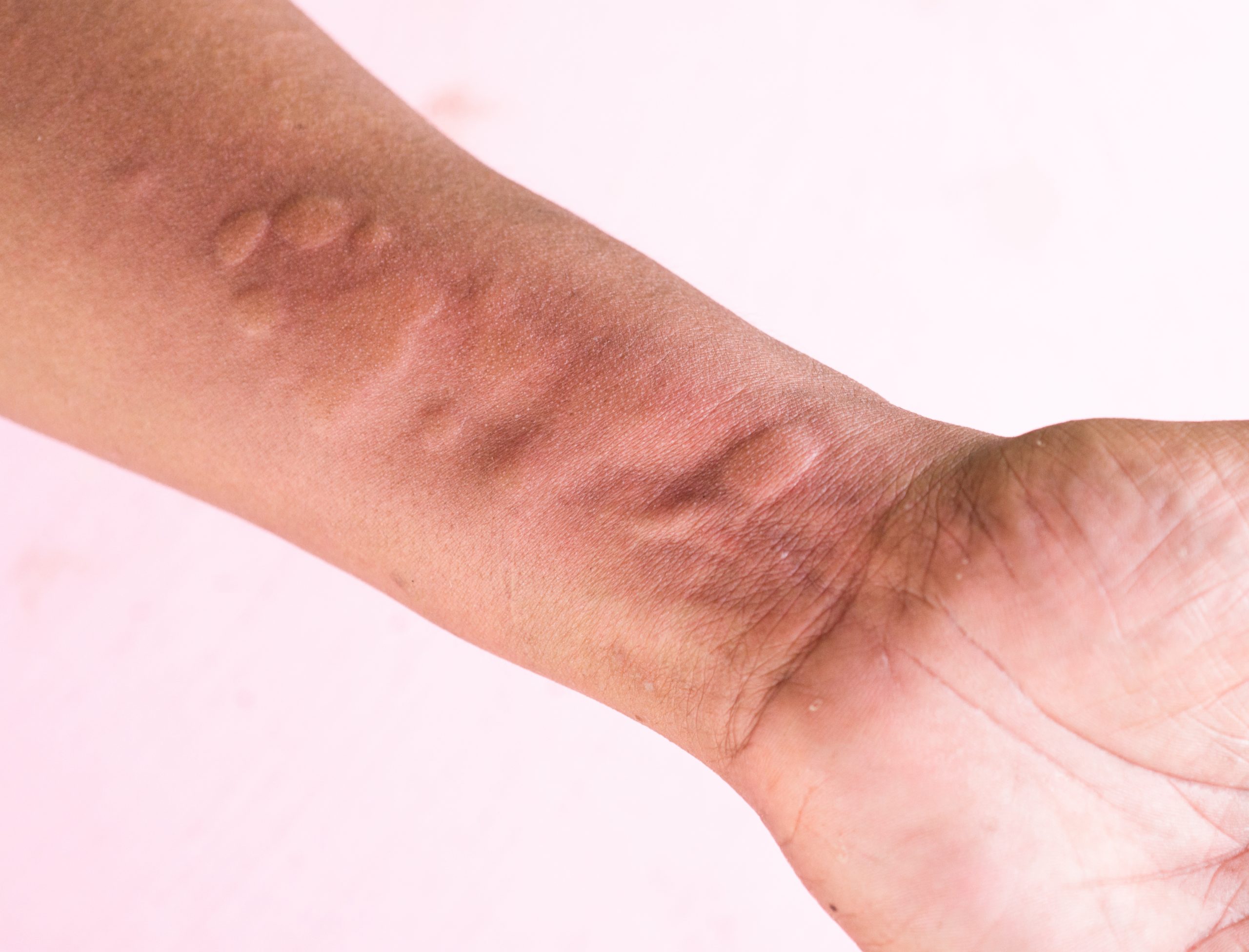 What is urticaria? RefLab ApS