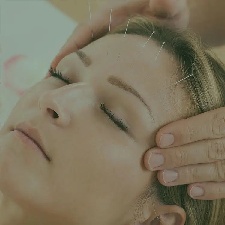 Acupuncture in Langley Reflex Physiotherapy