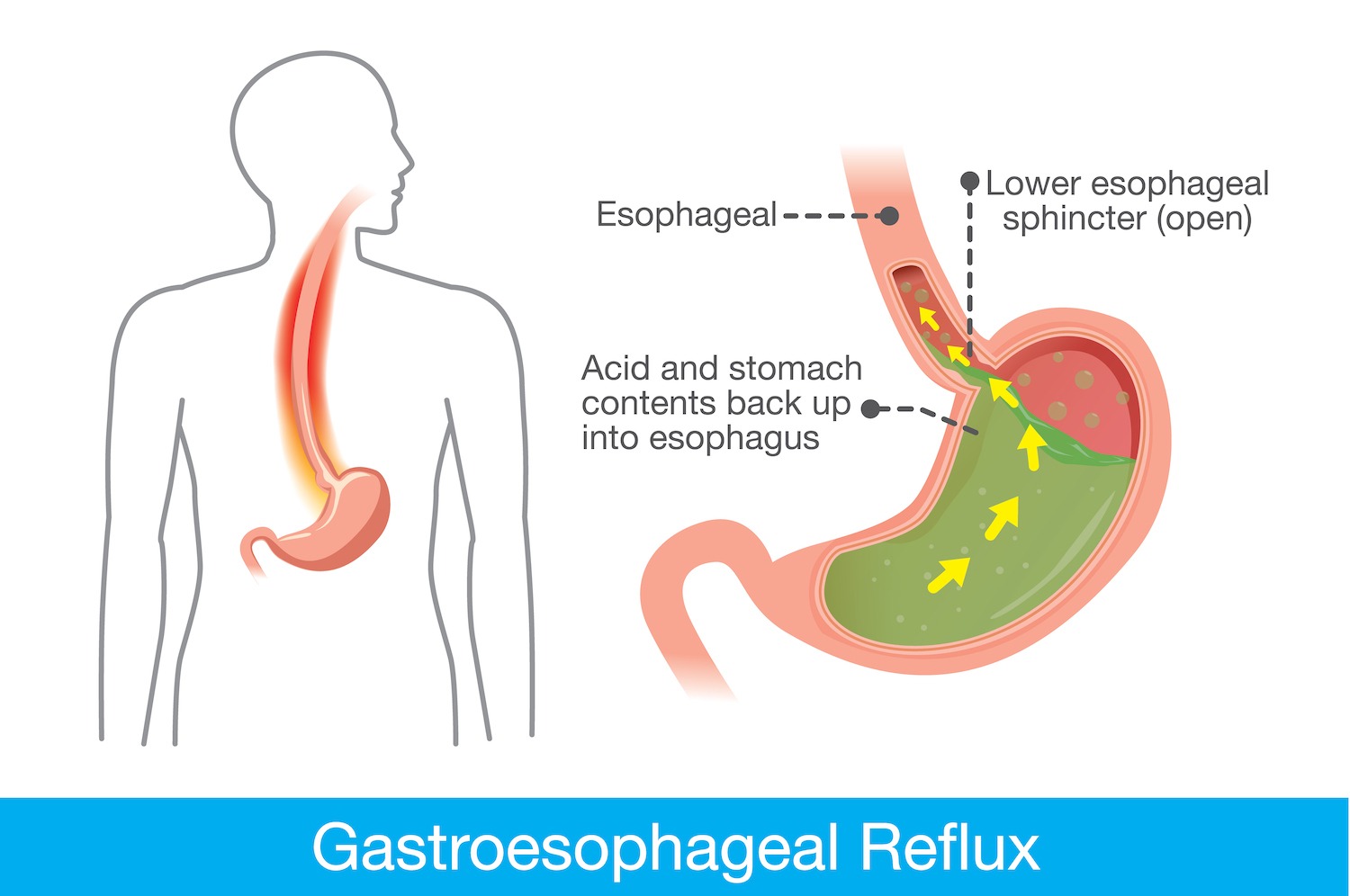 Understanding Acid Reflux Reflux Gourmet