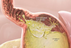 Reflux Oesophagitis? Ontdek Wat Je Nu Kan Doen Aan Deze Lastige Kwaal | Refluxstoppen