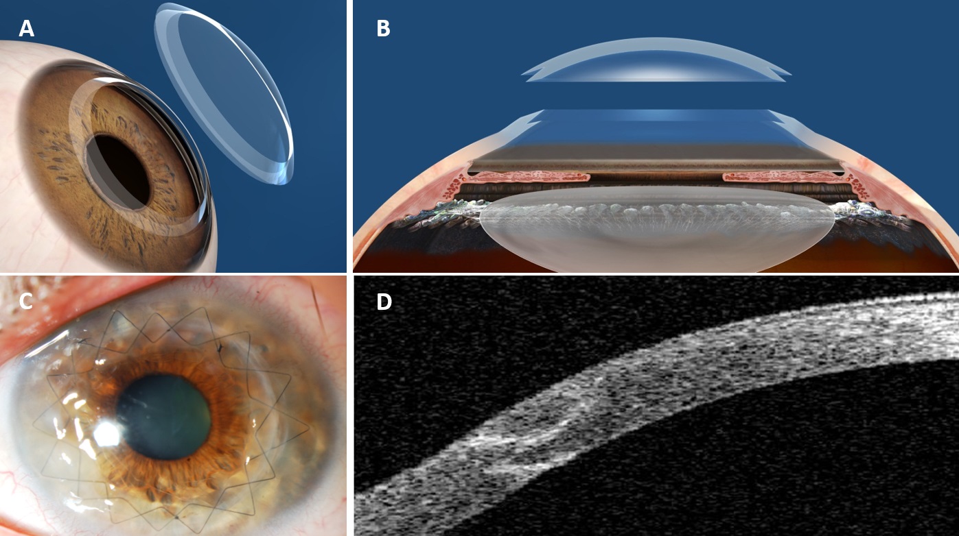Surgical procedures in keratoplasty Refractive Surgery Course