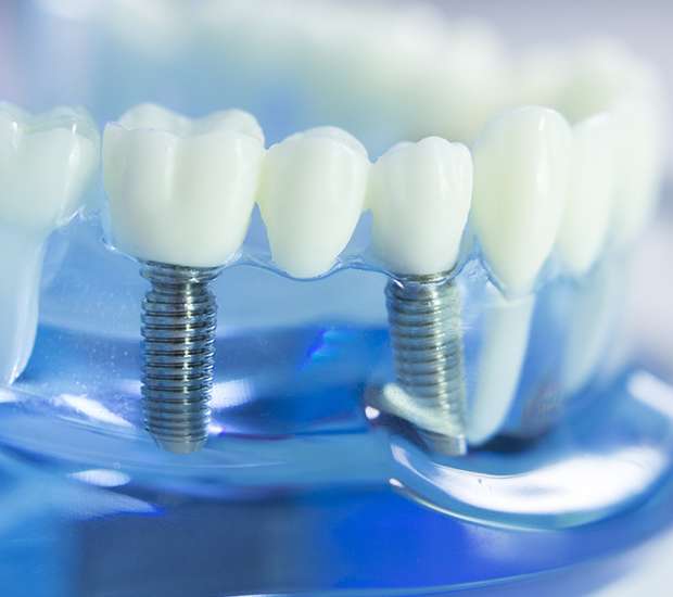 Dental Implants Boca Raton FL Regency Court Dentistry