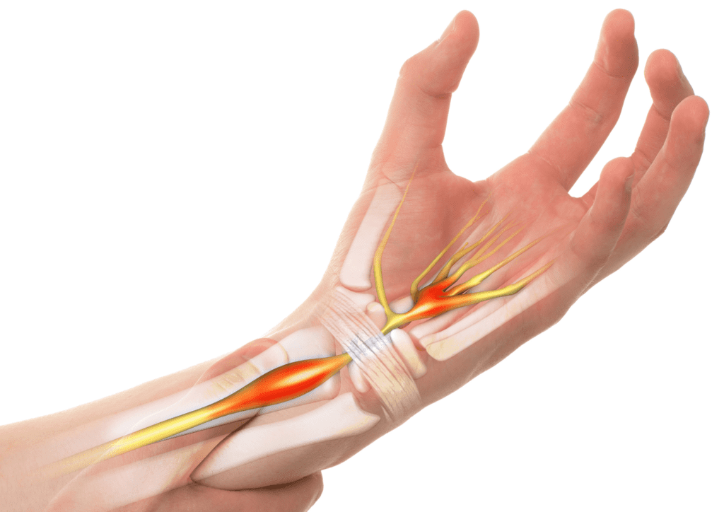 Hand and Wrist Pain Treatment in Ireland and UK Regenecare