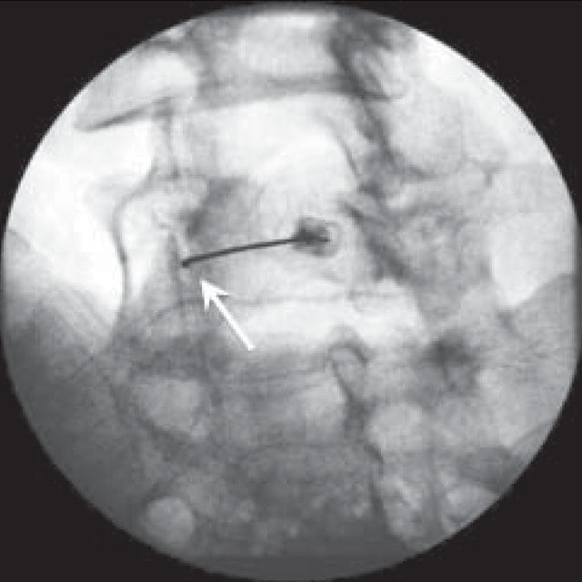 Brimhall Wellness Stem Cell Course A Review Regenexx