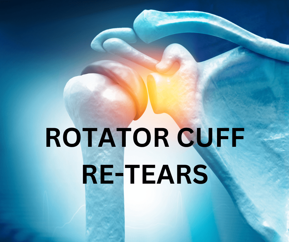 Rotator Cuff Retears Reduced with Bone Marrow Concentrate Regenexx
