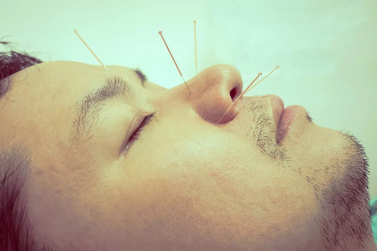 Acupuncture for Allergies Freehold, NJ REHABILITY