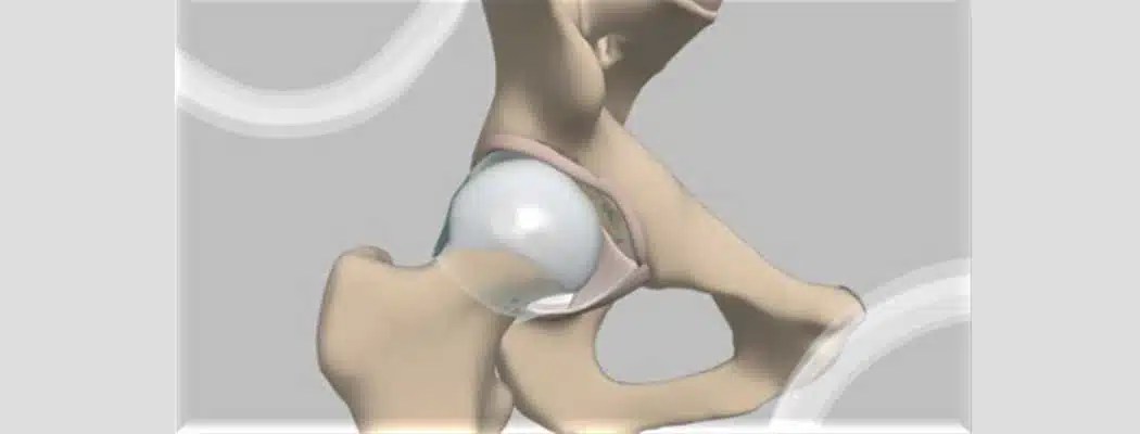 Diagnose Hip Dysplasia Special Tests Free Course Physical Therapy