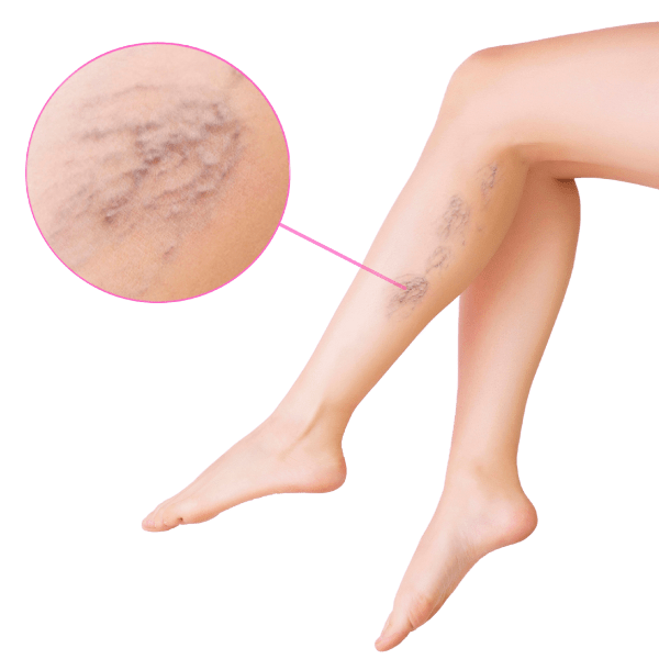 Varicose Veins Treatment in Sugar Land, TX