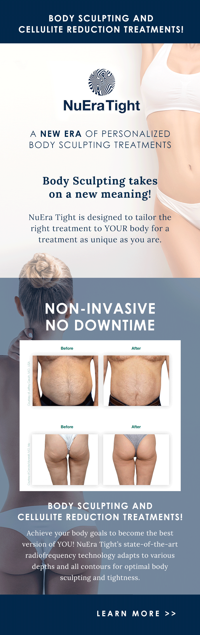 Introducing NuEra Tight Rejuvene MD