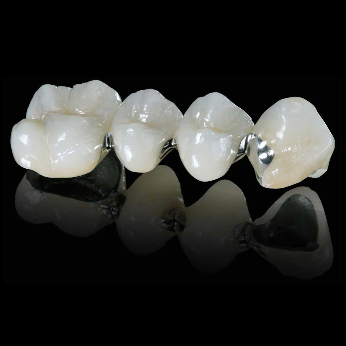 Porcelain Fused to Metal(PFMs)