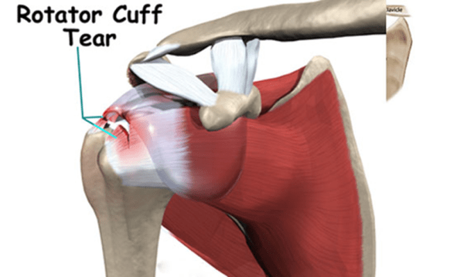 Shoulder Pain Cause.Treatment ReLiva Physiotherapy Rehab