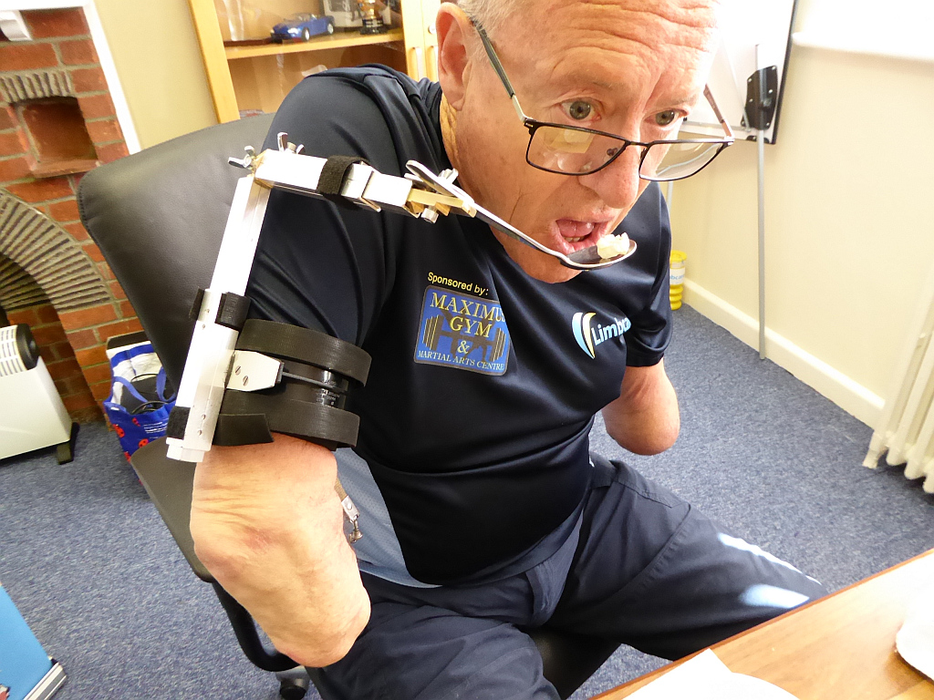 Eating aid for double amputees REMAP Custom made equipment for