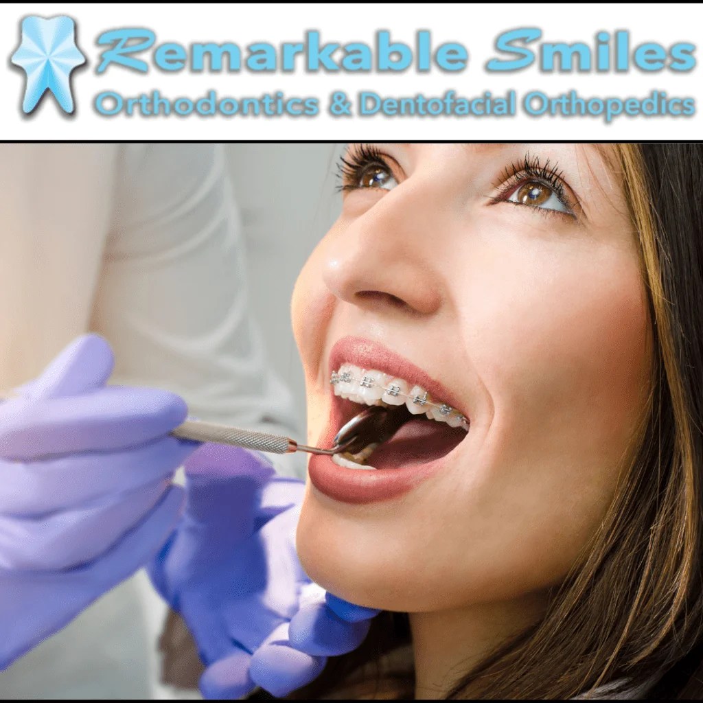 What Causes People to Need Braces? Remarkable Smiles
