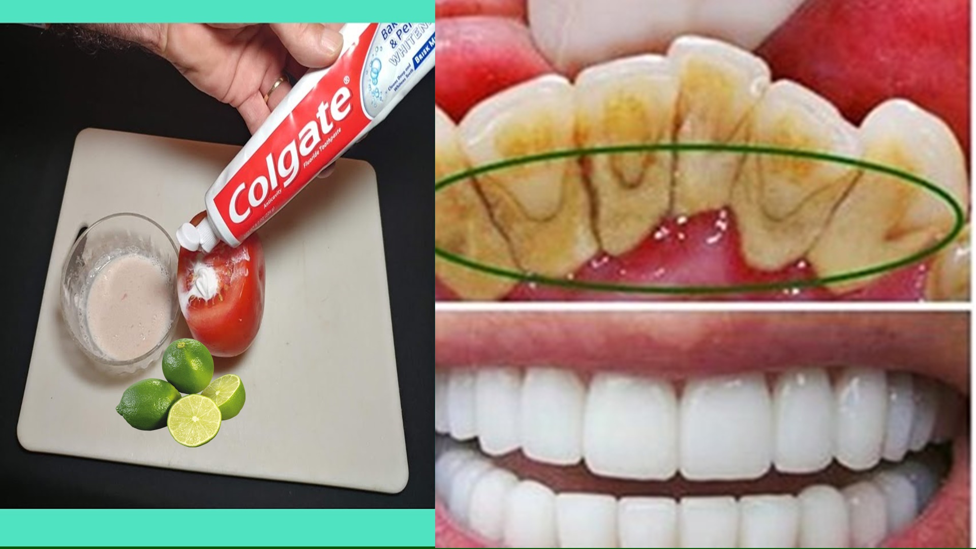 Blanquear los dientes naturalmente con este método Remedios consejos