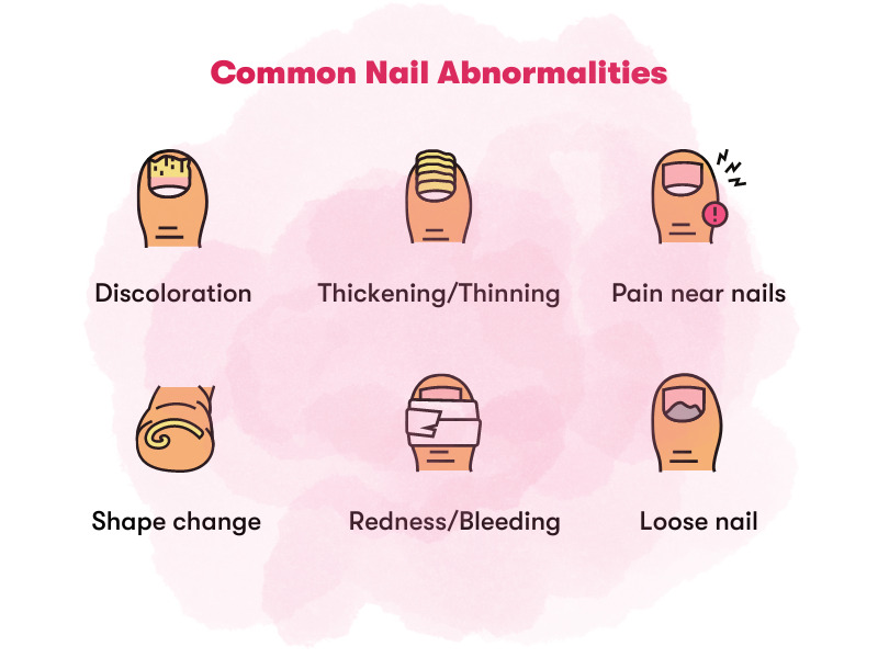 When Should You See a Dermatologist about Nail concerns?