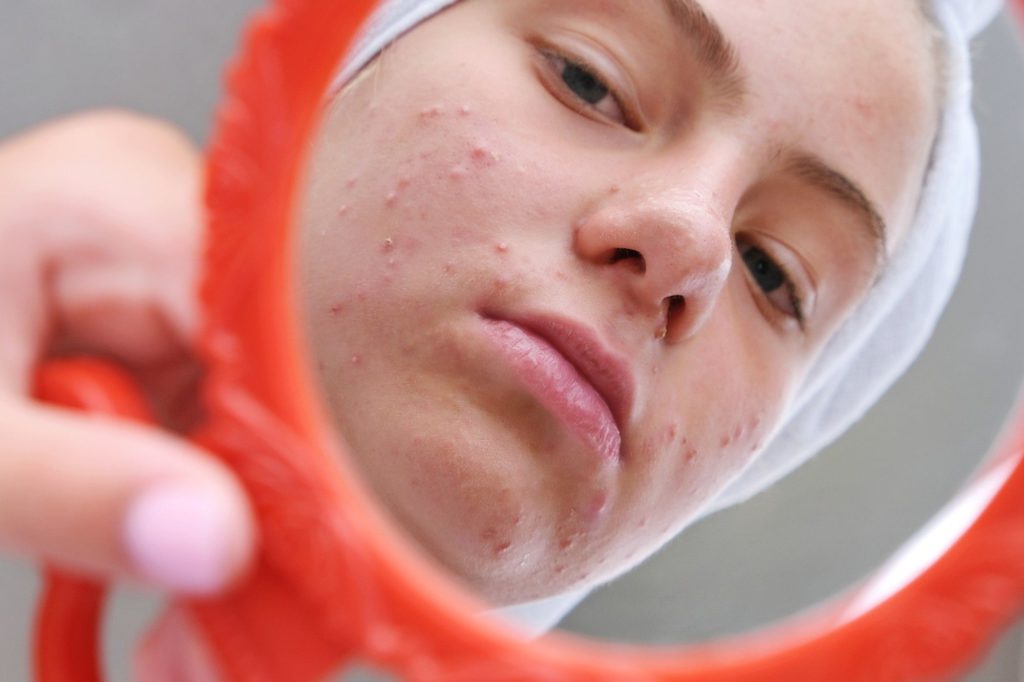 Whiteheads Causes, Treatment and Prevention Remotederm