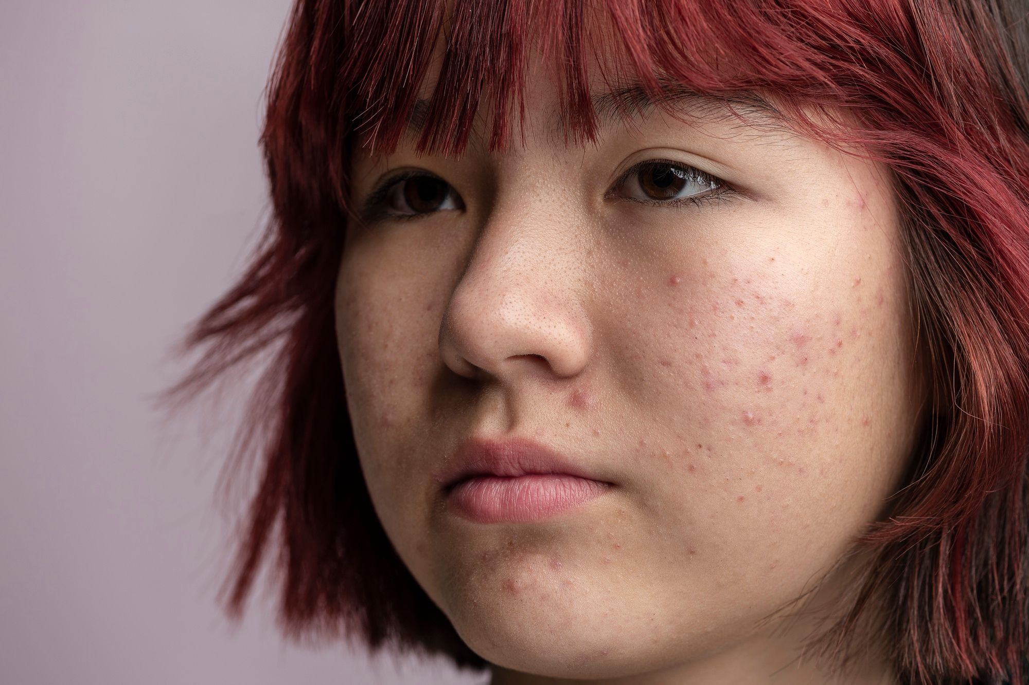 Whiteheads Causes, Treatment and Prevention Remotederm