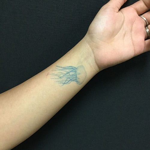 What to Know About Color Tattoo Removal Removery