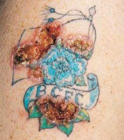 Tattoo Allergy: Can You Be Allergic To Tattoo Ink? | Removery 282_x_250_jpg