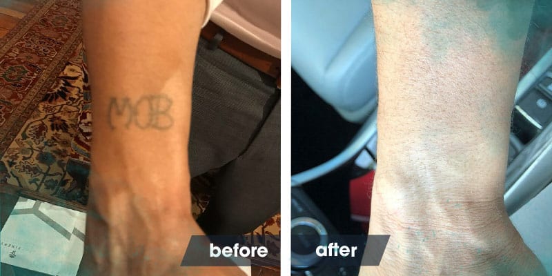 Innocent Man Starts Life Outside Of Prison With Tattoo Removal | Removery 400_x_800_jpg