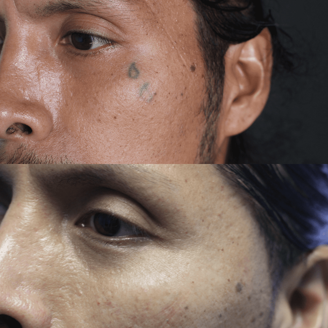 Face Tattoo Removal Services Removery