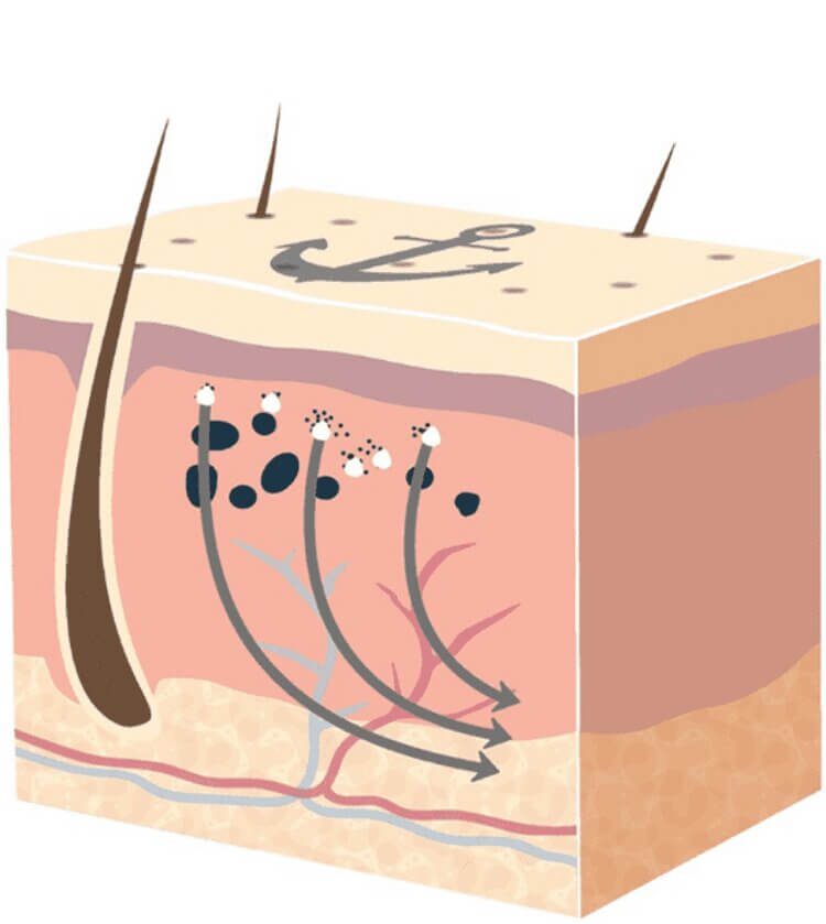 How Does Laser Tattoo Removal Work? Removery