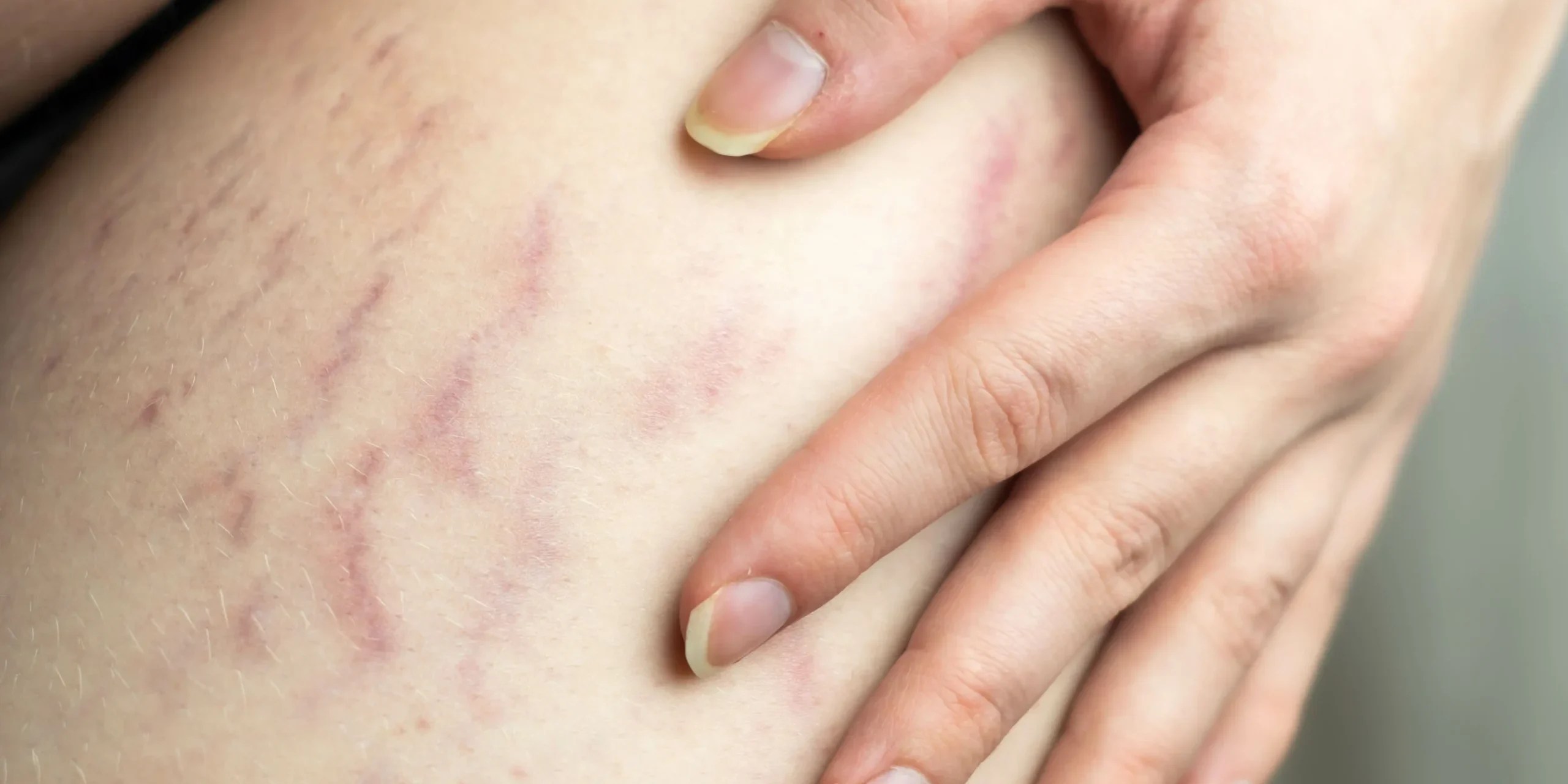 Stretch Mark Cover Up Tattoos Before and After Removery