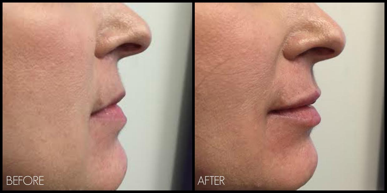 Lip Filler Before And After Pics Thin Lips(028)