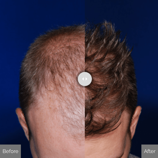 How Much Does Hair Restoration Cost? Renee Burke, MD