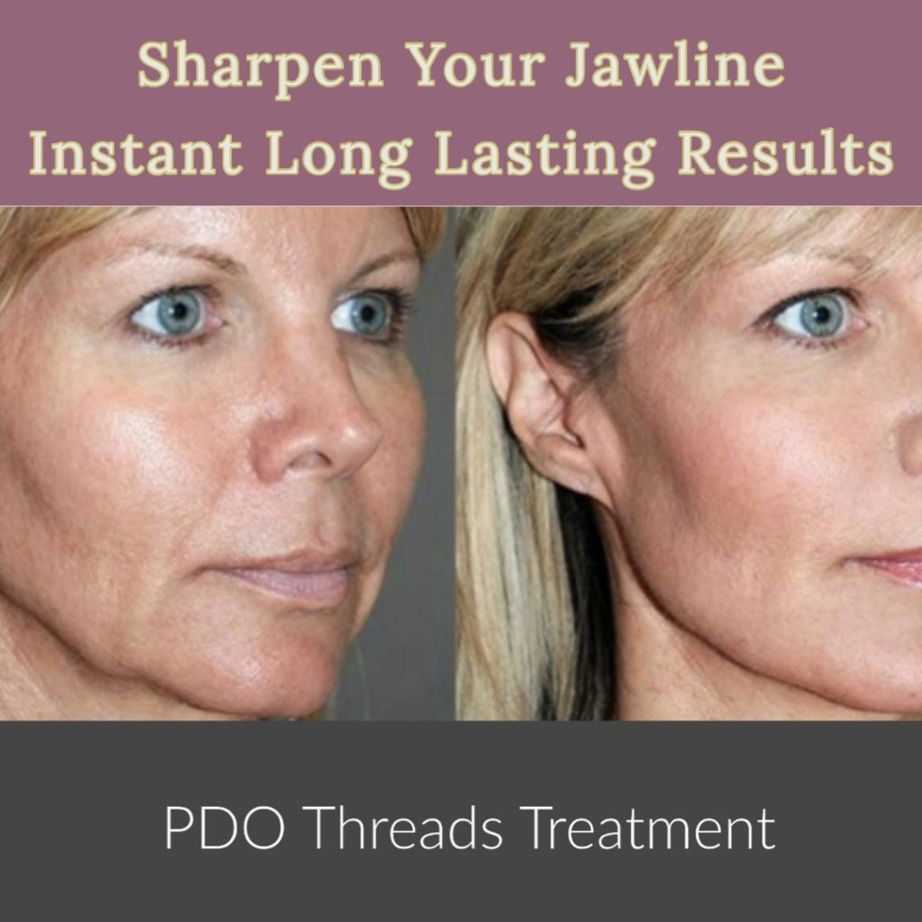 PDO Thread Lift Eliminate Sagging Skin Renew