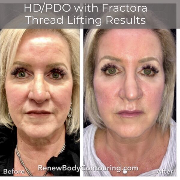 PDO Thread Lift Eliminate Sagging Skin Renew