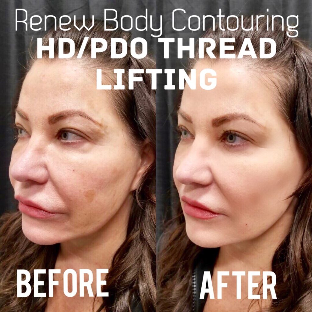 PDO Thread Lift Eliminate Sagging Skin Renew