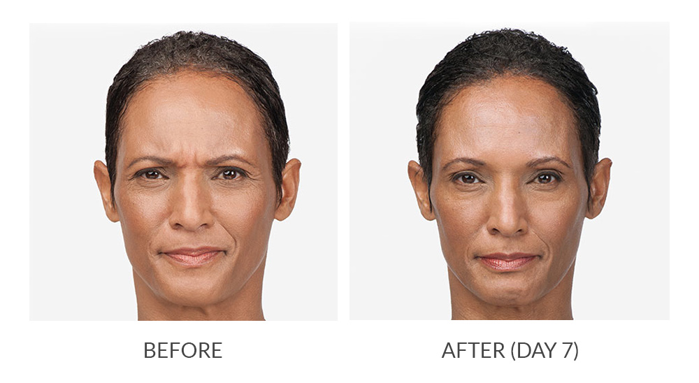 BOTOX® Cosmetic Before & After Photos Renew MedSpa