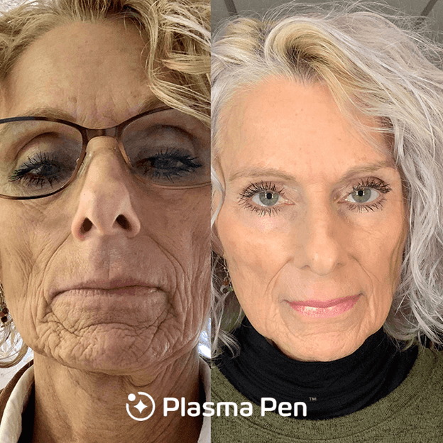 Facelift Treatment Renew MedSpa