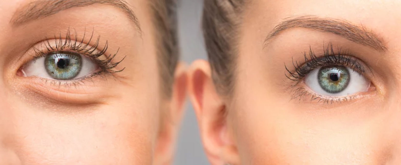 PRP/PRF Eye Rejuvenation Renew MedSpa
