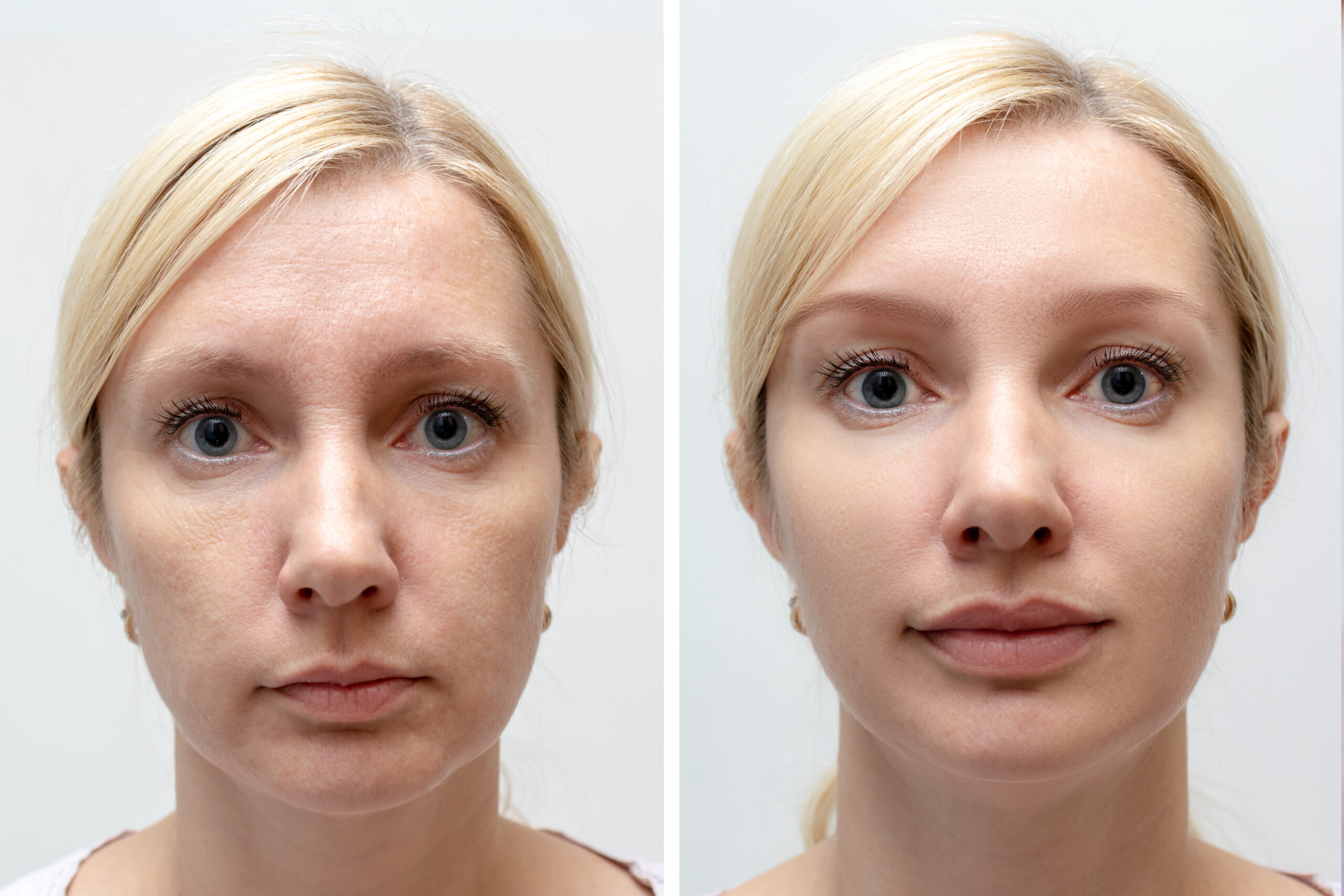 DERMAL FILLERS Aesthetics Therapy Los Angeles