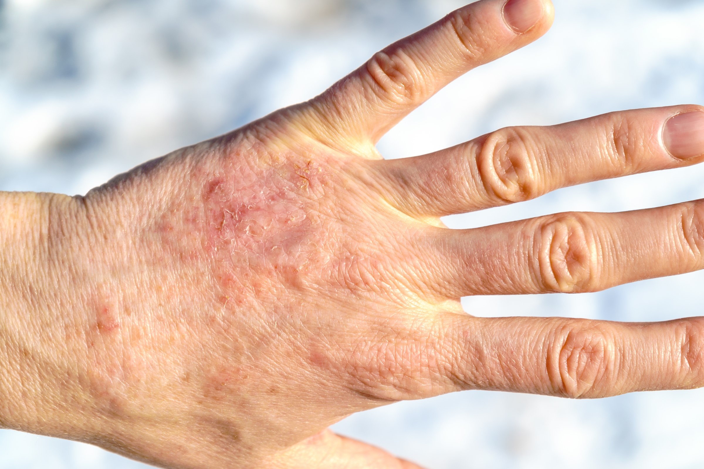 Eczema Reno Tahoe Dermatology Best Reno Dermatologist