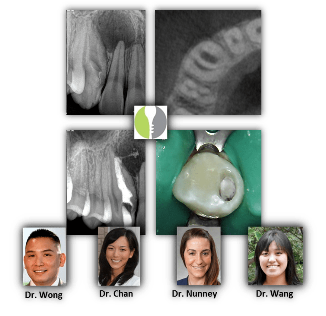 Zombie Tooth Renovo Endodontic Studio