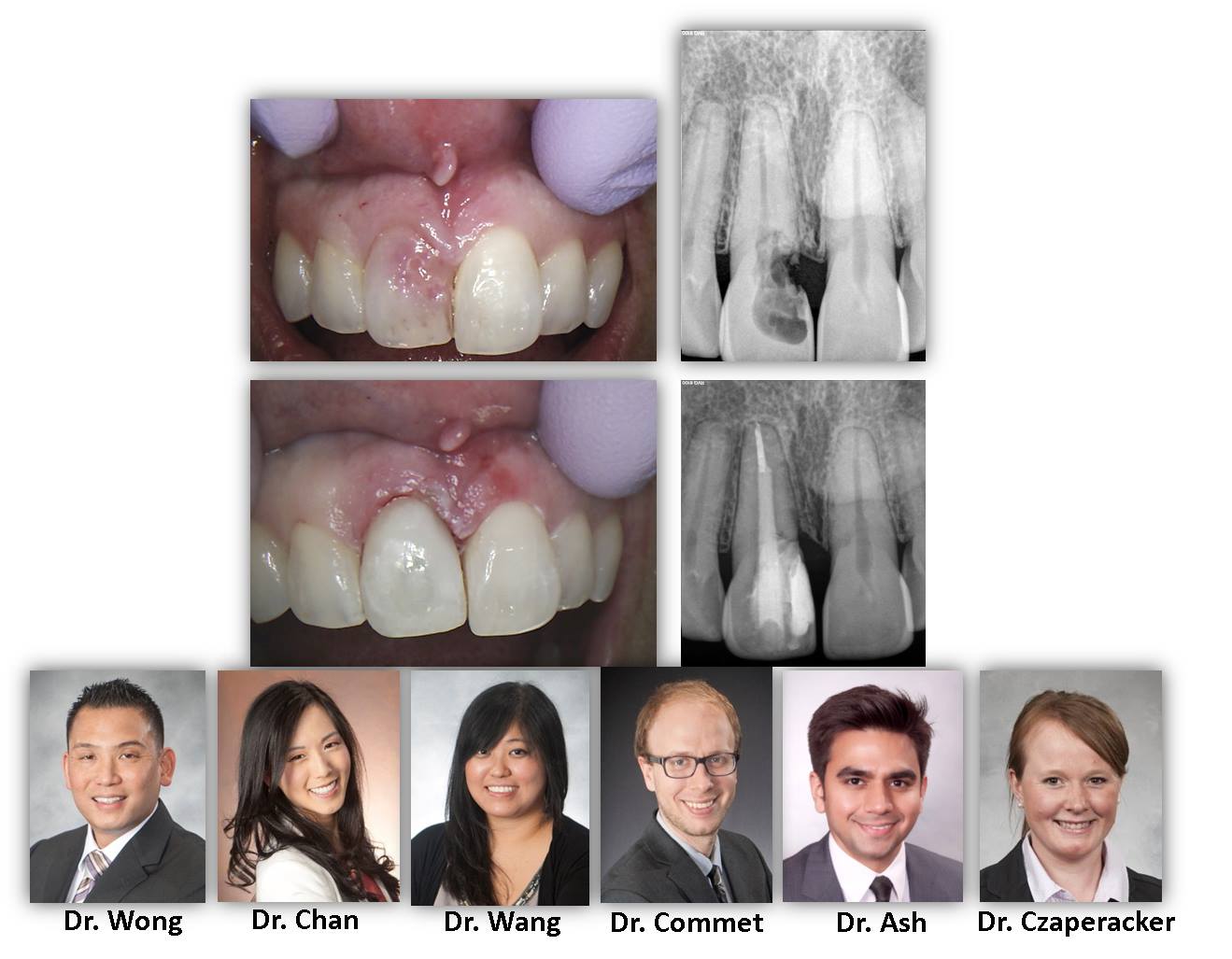 MASSIVE TOOTH RESORPTION Renovo Endodontic Studio