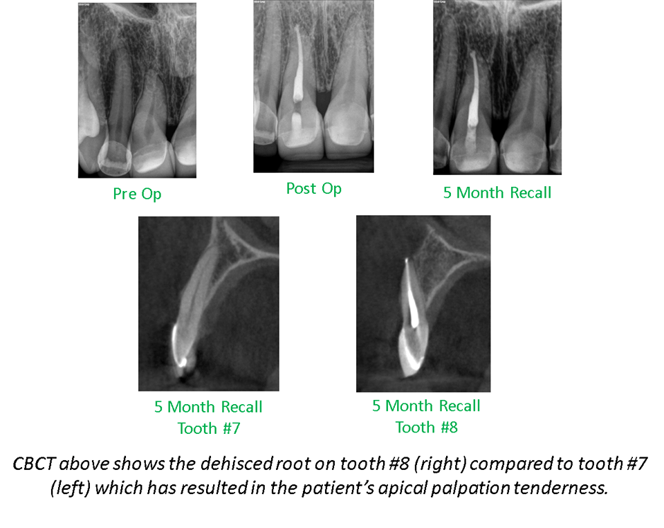PERSISTENT PAIN FOLLOWING RCT Renovo Endodontics Studio