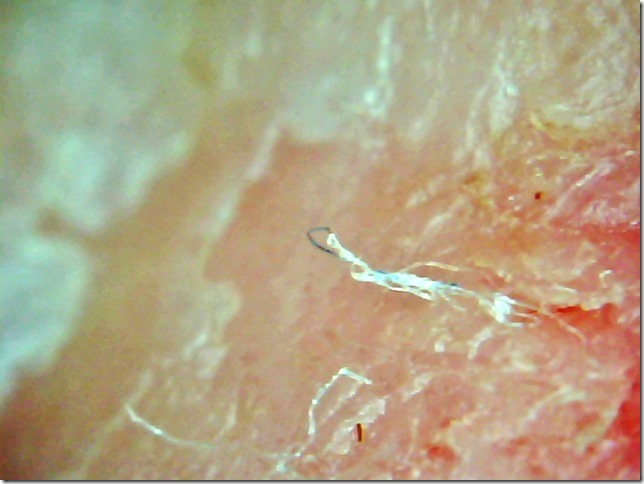 Jan Smith's CDC Says It's 'Delusional Parasitosis'