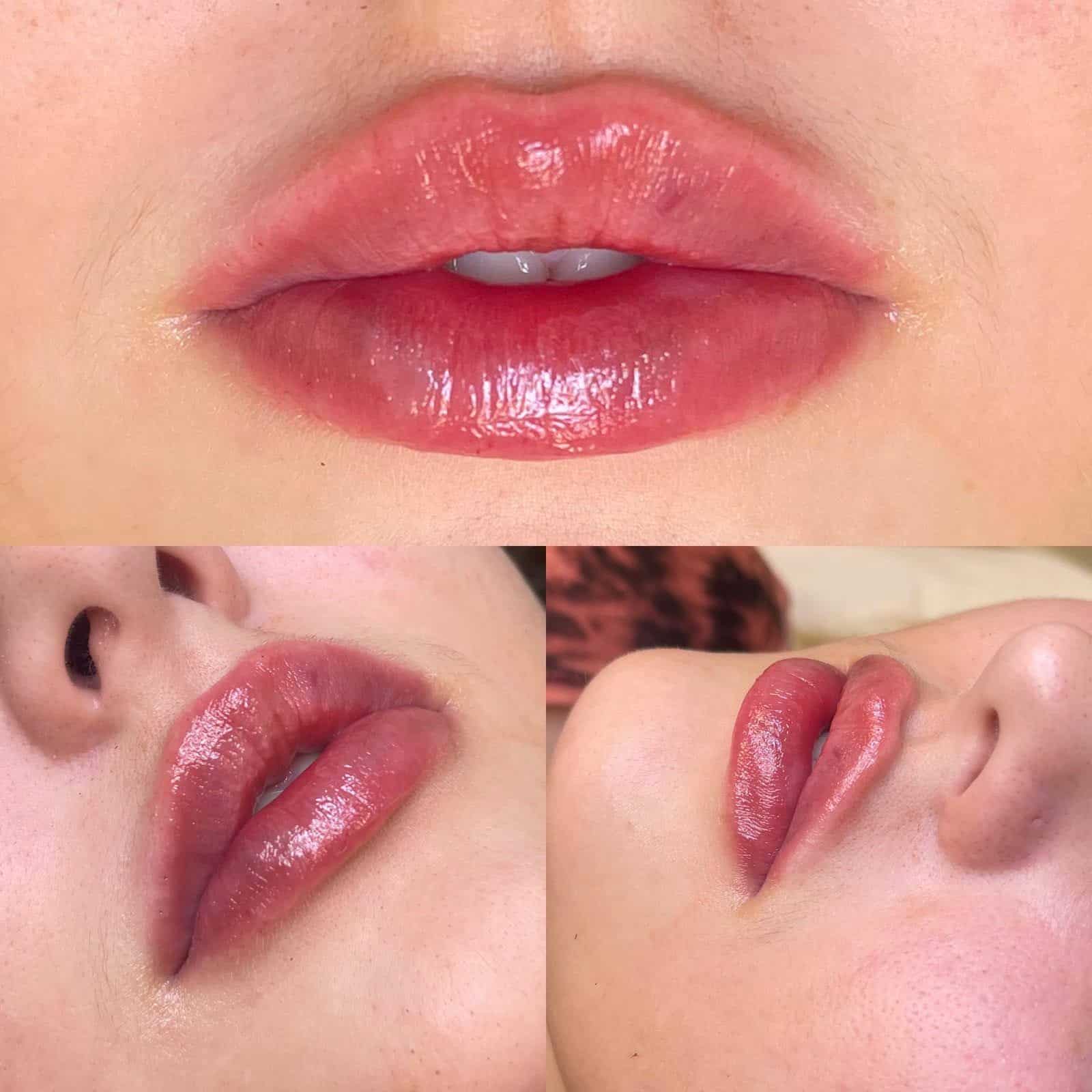Lip filler before and after Jupiter, Stuart, and Tequesta