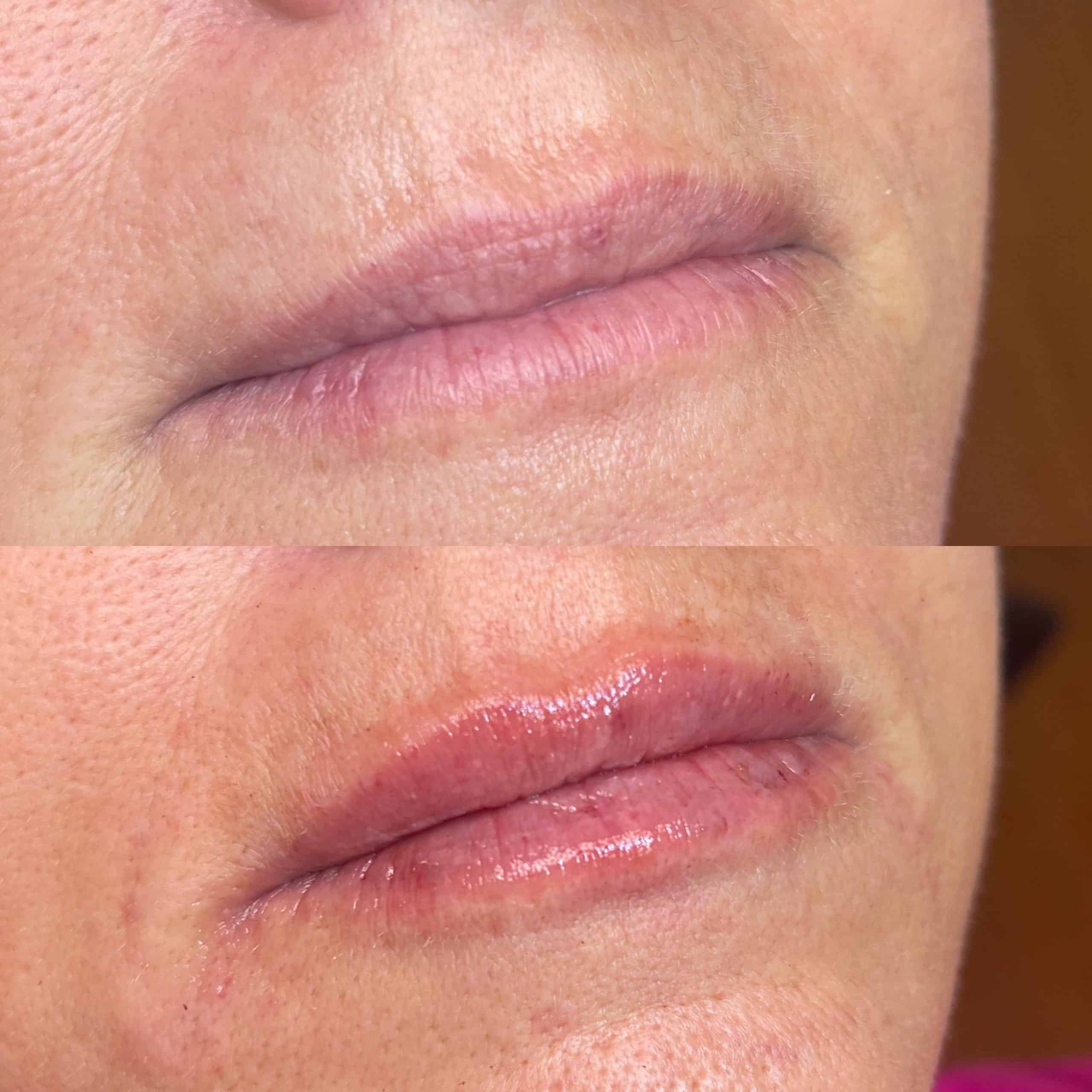 Lip filler before and after Jupiter, Stuart, and Tequesta
