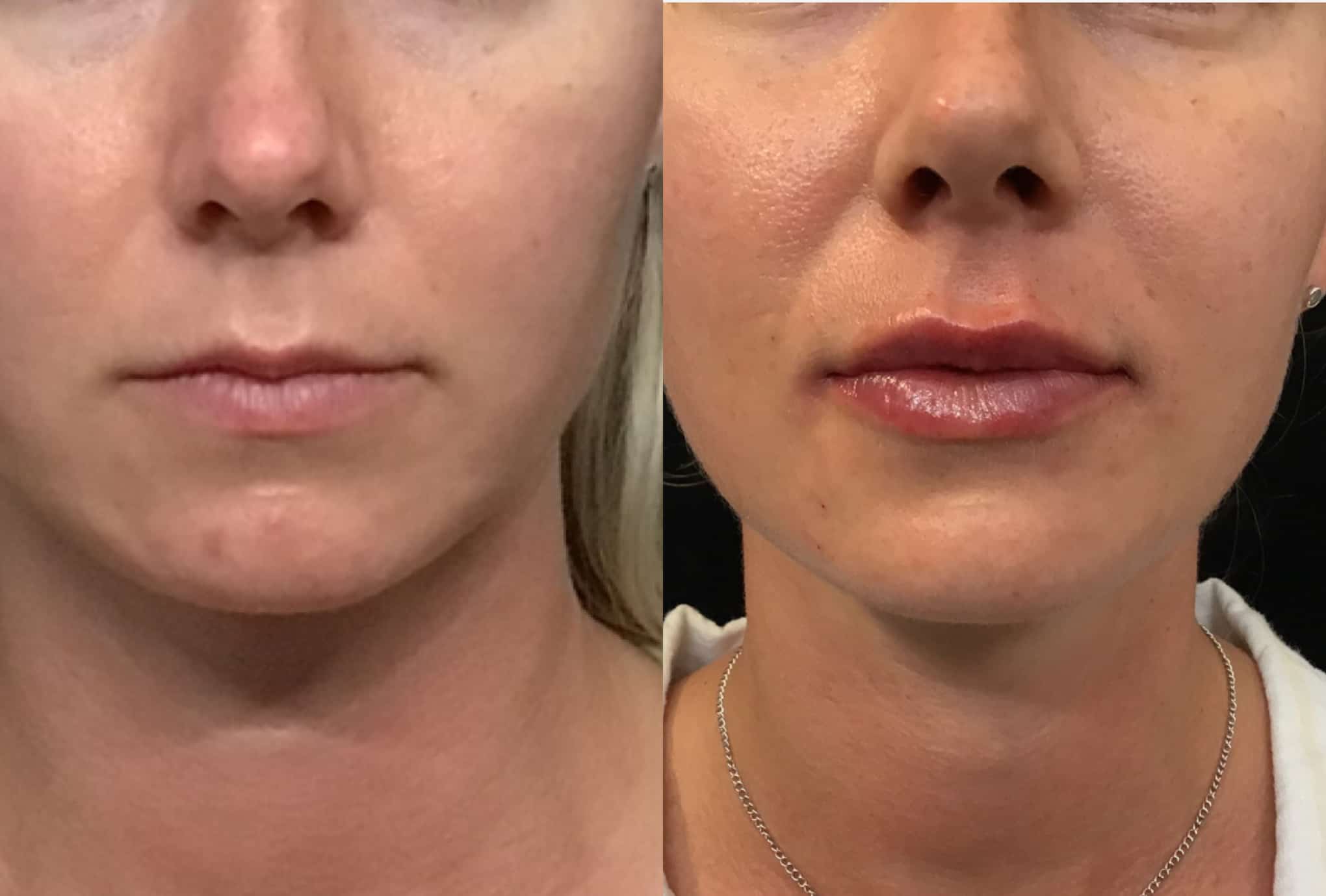 Lip filler before and after Jupiter, Stuart, and Tequesta