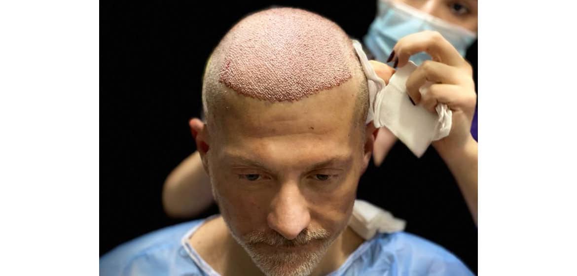 Before and after hair transplant StepbyStep Situation RepHair