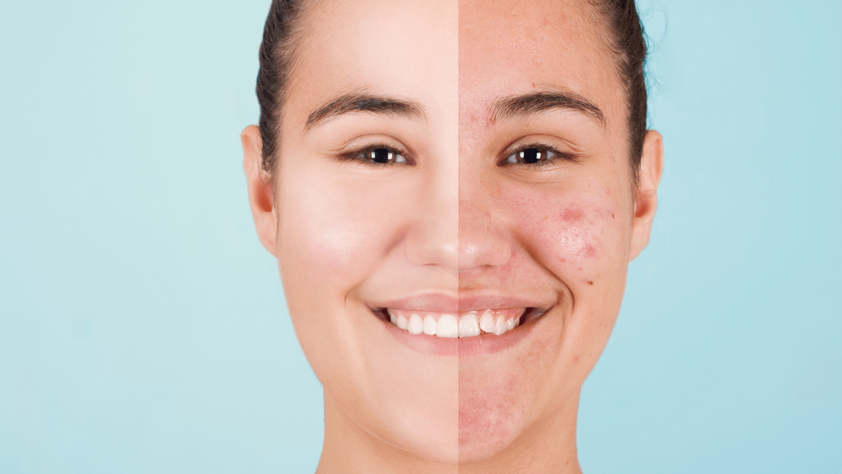 What Supplements to Get Rid of Acne Scars A Complete Guide Replenish